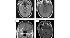 Sphenoid Wing Meningioma Presenting With a Temporal Fossa Mass