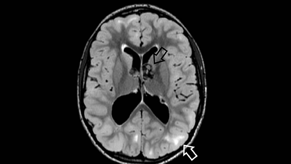 Tuberous Sclerosis Complex