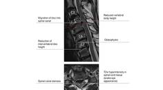 Degenerative Cervical Myelopathy as a Neuromuscular Mimicker