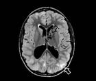 Tuberous Sclerosis Complex