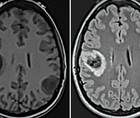 Challenge Case Report New Onset Seizures and Brain Lesions in First Trimester