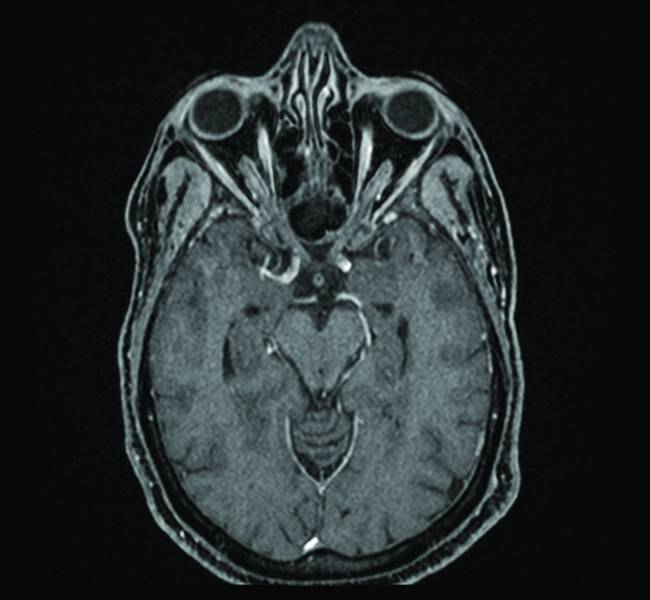 Perez Fig 2C Optic Nerve Image