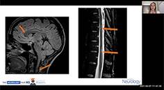 pregnancy and multiple sclerosis thumb new