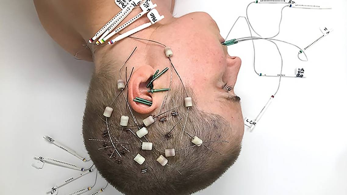 The Many Challenges of Drug Resistant Epilepsy