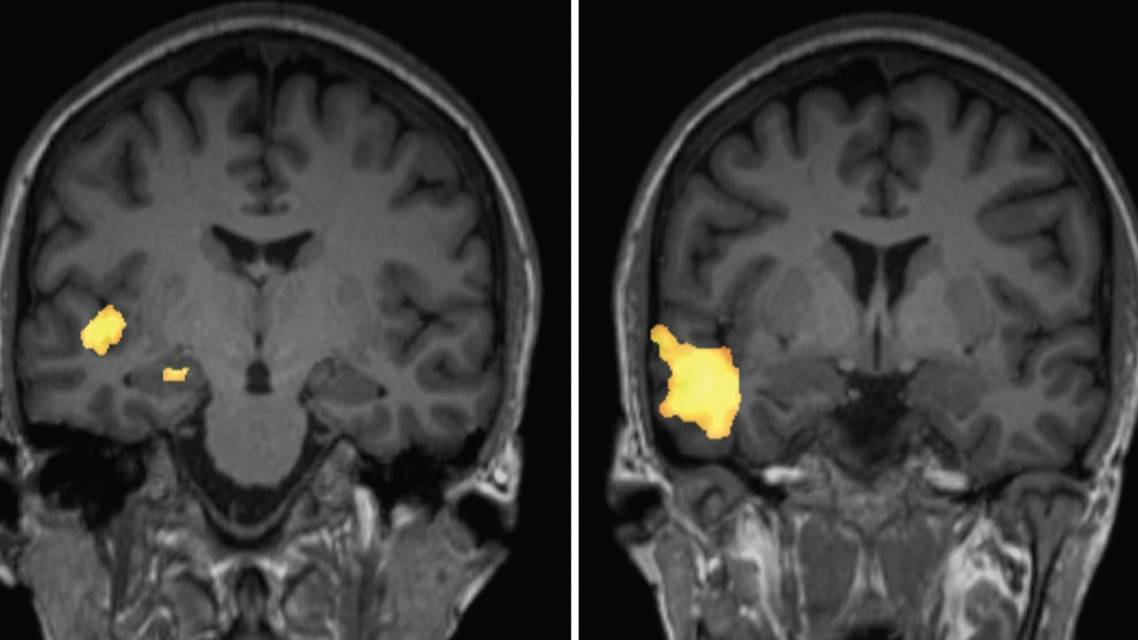A Case of AntiGAD65 Autoimmune Musicogenic Epilepsy