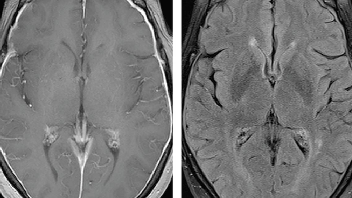 Meningeal Enhancement Seen on Workup for Memory Loss
