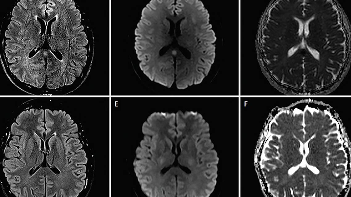 Reversible and Benign Lesions of Splenium of The Corpus Collosum