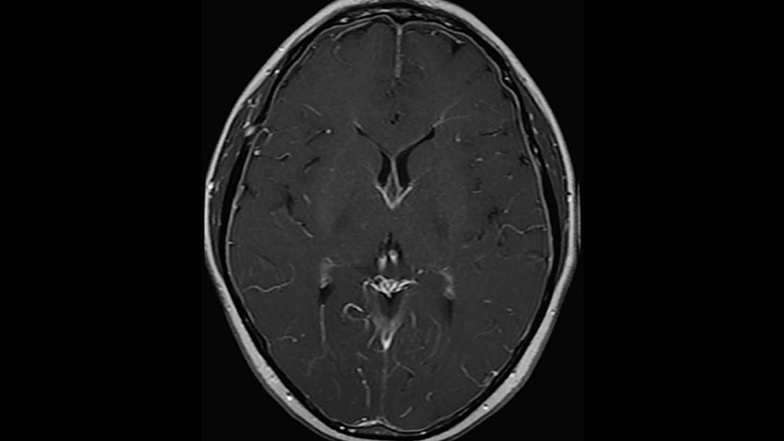 Case Report New Onset Headache With Tinnitus andOrthostatic Dizziness