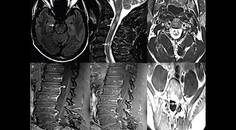 MOG Antibody Disease