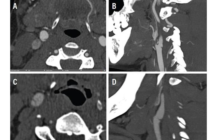 Stroke Snapshot Carotid Artery WebsEpidemiology and Pathophysiology