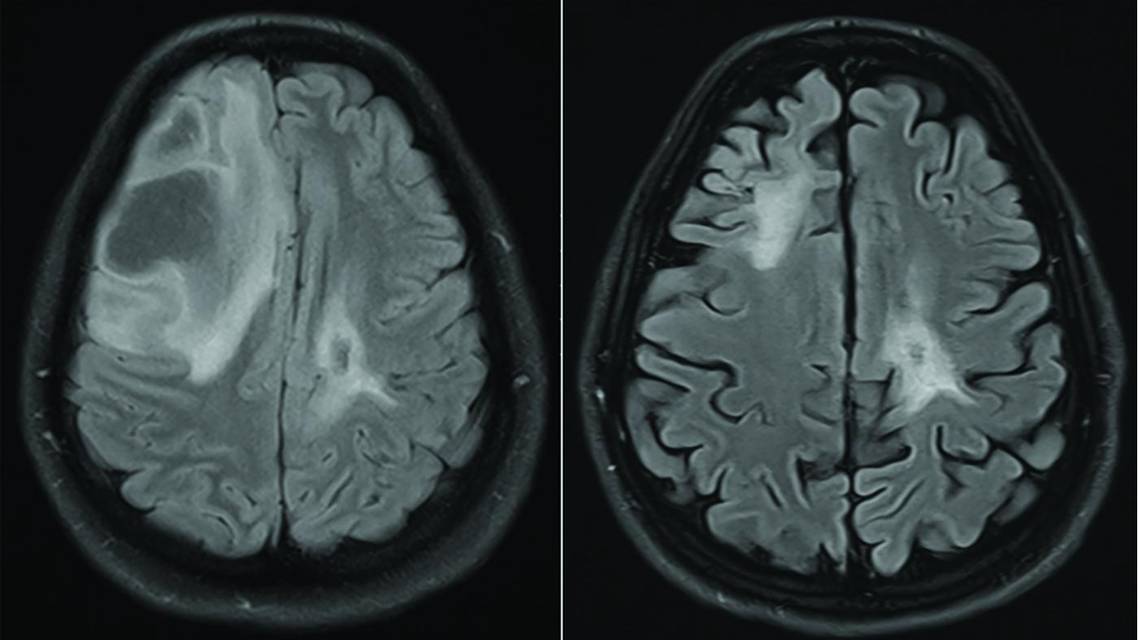 Figure 1 depicting the MRI of a brain