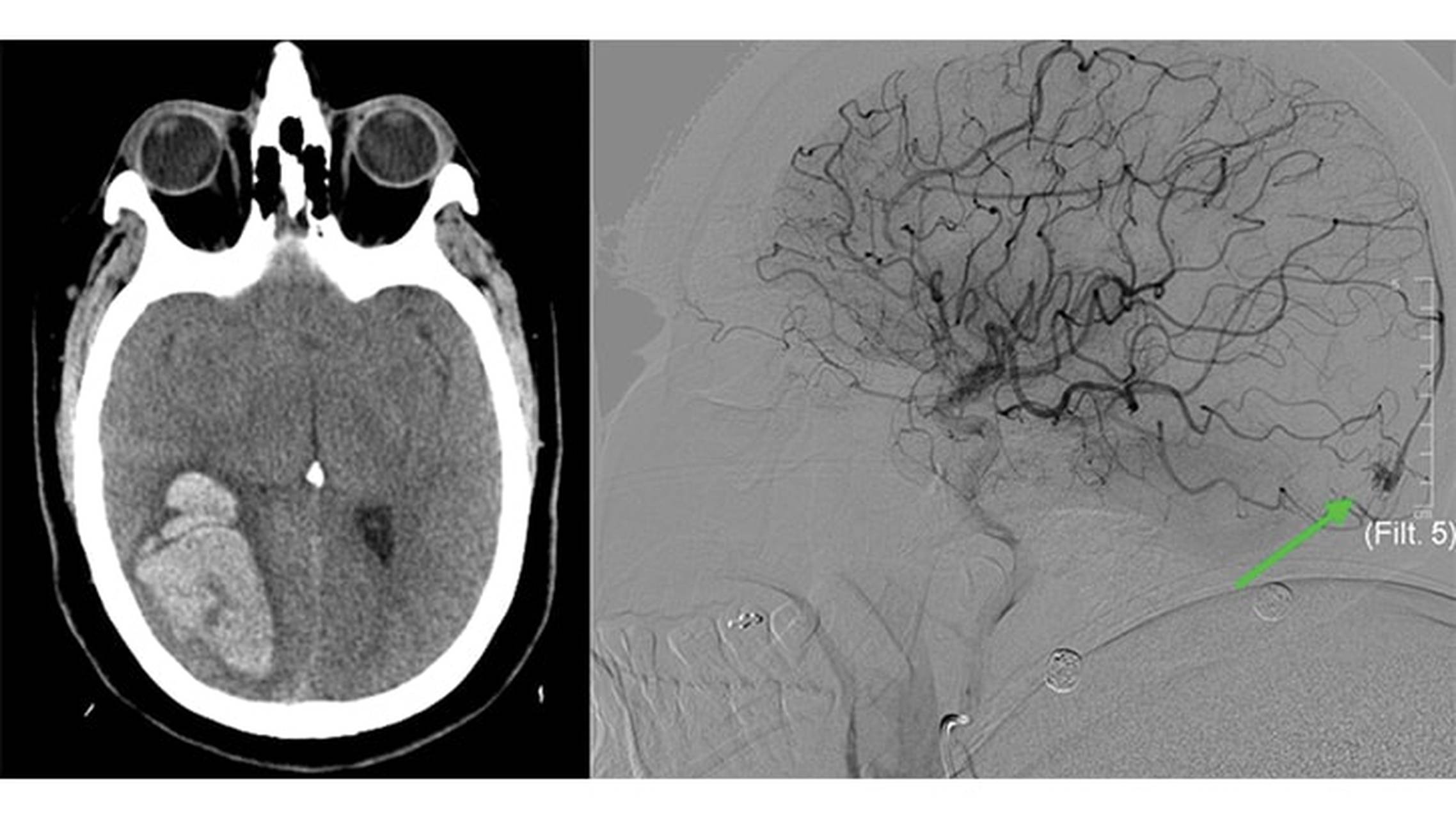Fistula Rupture Spontaneous Intracranial Hemorrhage Secondary to Rare Pial A