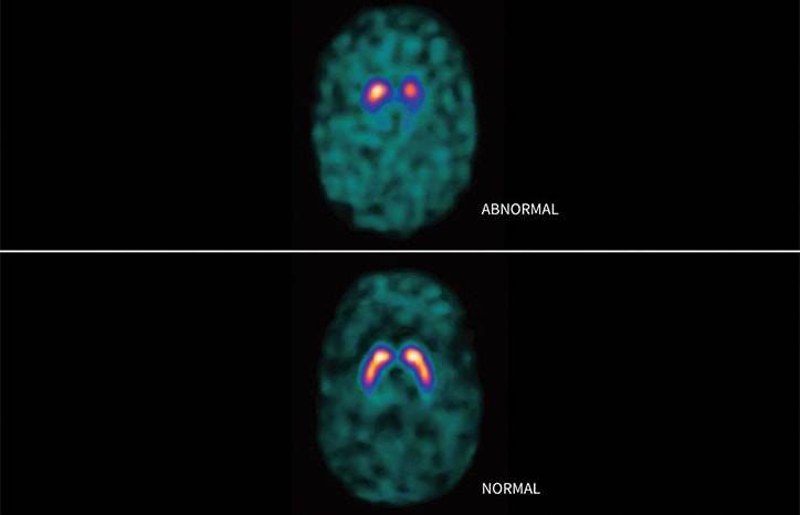 Updates in Diagnostic Testing in Parkinson Disease