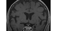 Stroke Snapshot Intracranial MRI Vessel Wall Imaging