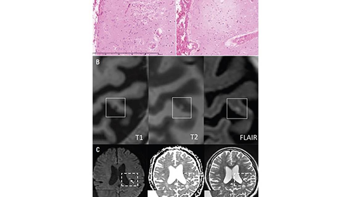 Stroke Snapshot Cerebral MicroinfarctsEtiology and Clinical Implications of This Novel MRI Marker