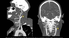 Corpus Callosum StrokeA Rare Localization for an Isolated Cerebral Infarction