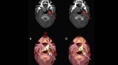 Glossopharyngeal Neuralgia