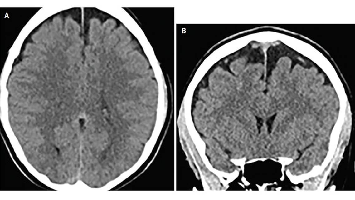 Case Report Delayed Subdural Hematoma