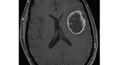 Challenge Case Report Subacute Cognitive Decline