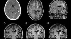 Parry Romberg Syndrome With Drug Resistant Epilepsy