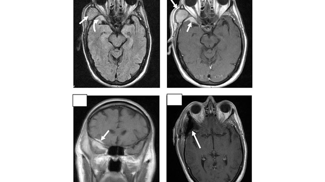 Sphenoid Wing Meningioma Presenting With a Temporal Fossa Mass