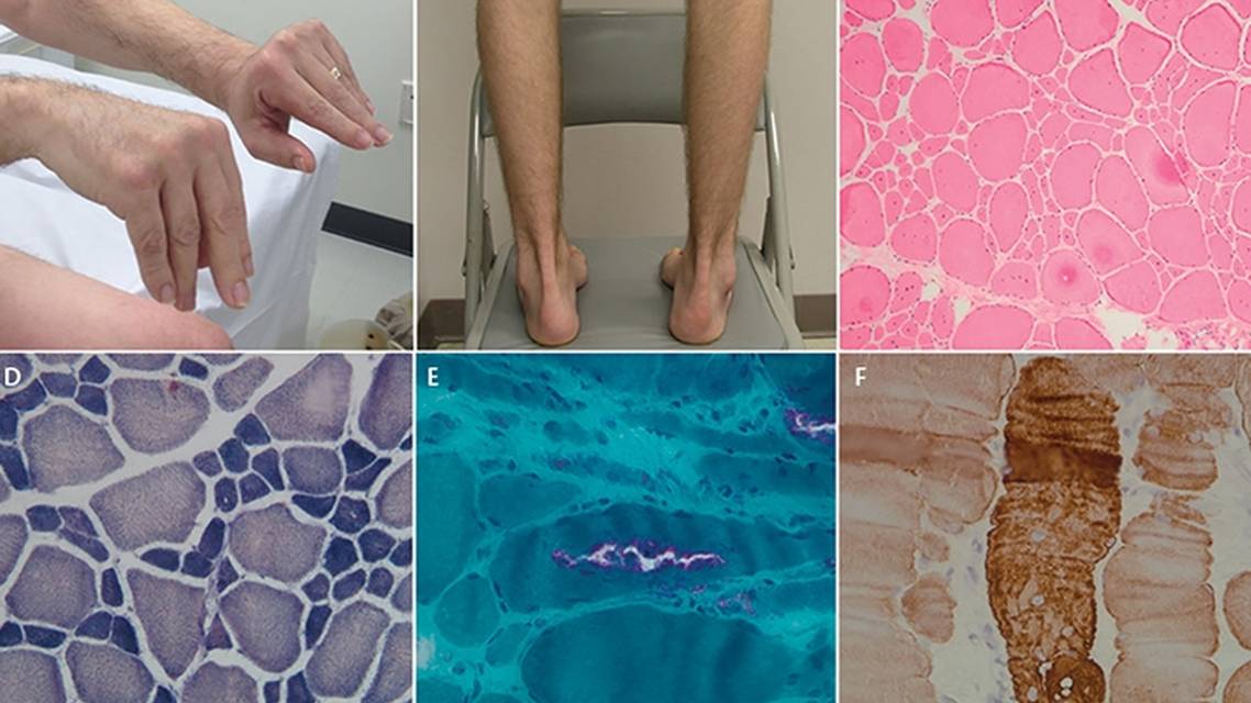 Differential Diagnosis of Distal Myopathies