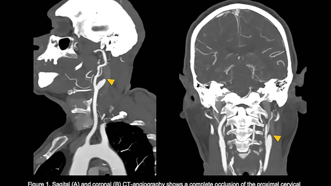 Corpus Callosum StrokeA Rare Localization for an Isolated Cerebral Infarction