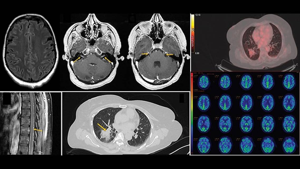 Rapidly Progressive Dementia and Plateau Waves A Rare Presentation of Leptomeningeal Disease
