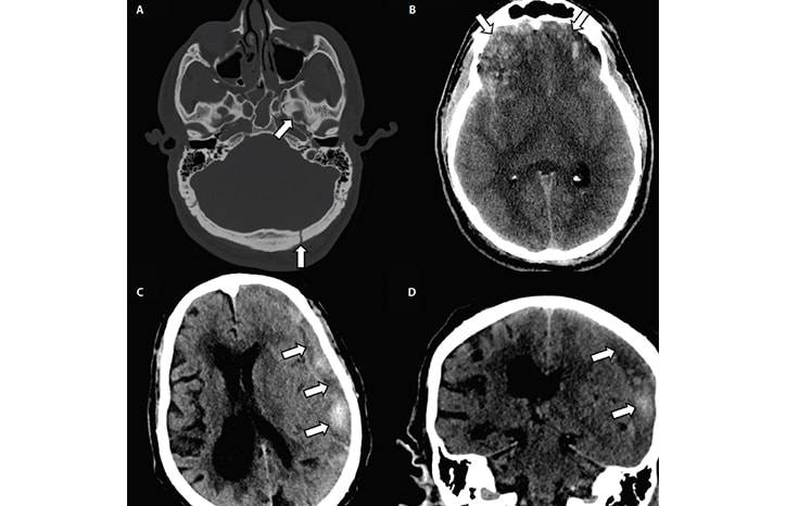 Neuroimaging Traumatic Brain Injuries