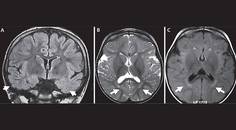 Early Onset Drug Resistant Epilepsy Due to Gene Variants