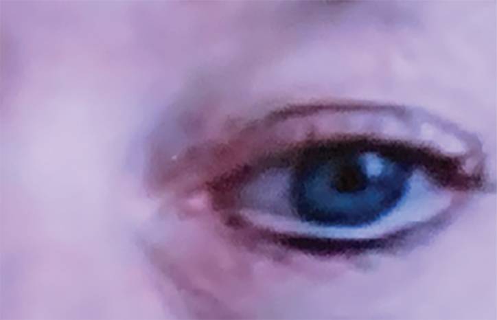 Teleneuro ophthalmology