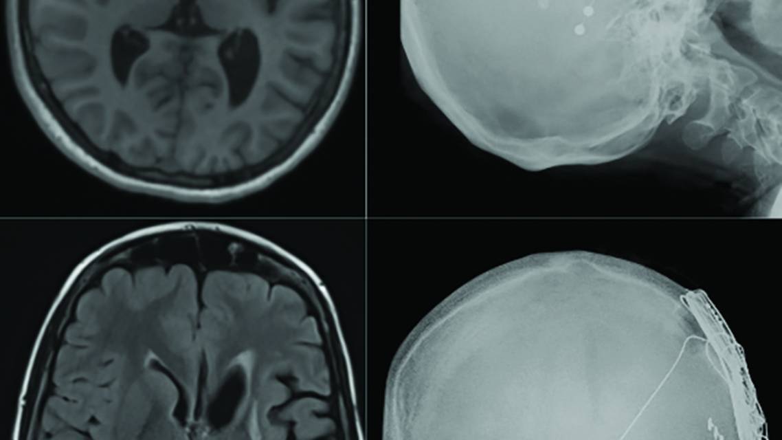 Figure 2 from the article by Fallah and Gallagher in the November 2025 issue of Practical Neurology