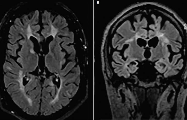 Case Report Hemiparkinsonism in a Patient With Multiple Sclerosis