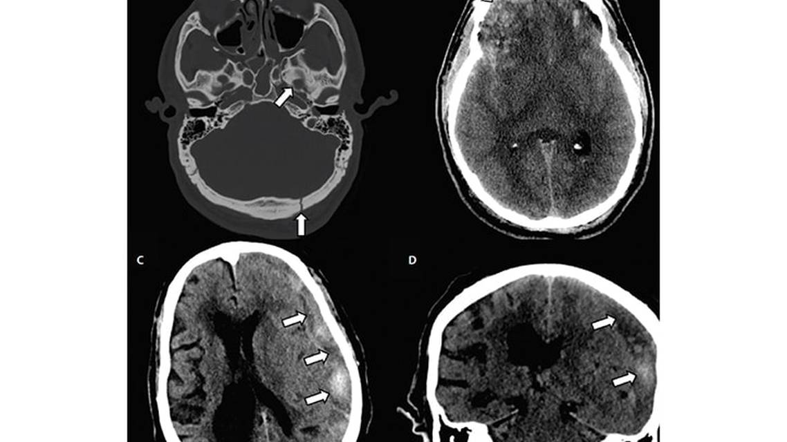 Neuroimaging Traumatic Brain Injuries