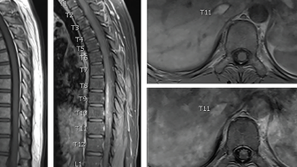 Neuroschistosomiasis