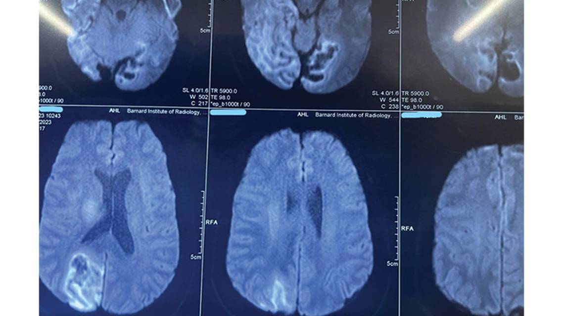 Disulfiram Ethanol Reaction Causing Cortical Blindness