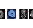 LGI1 Antibody Encephalitis Presenting as Focal Cortical Encephalitis