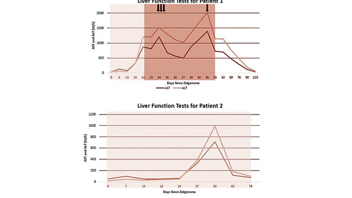 Case Report Elevated Transminases After Spinal Muscular Atrophy Treatment