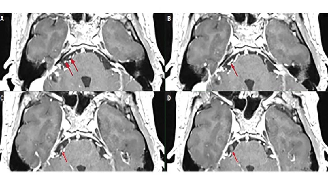 Arteriovenous Malformations and Trigeminal Neuralgia