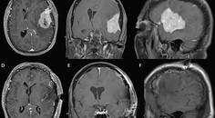 Challenge Case Report A Woman With a Large Dural Based Lesion