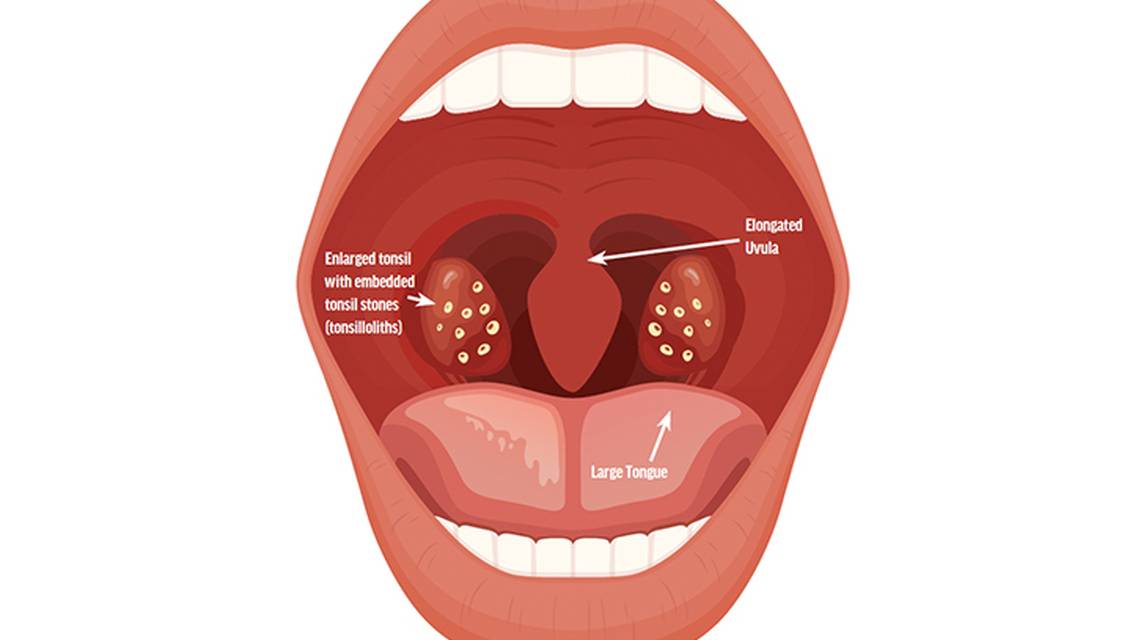 Tonsillectomy for the Treatment of Suspected Sleep Apnea with Subsequent Improvement of Chronic Migraine