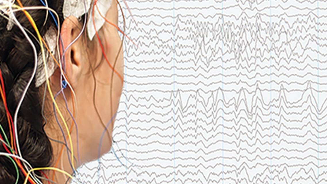 The Evolution of Seizure to Epilepsy
