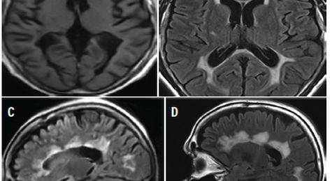Cord Infarct Pattern Spinal Cord Infarct: Clinical & Imaging Pearls