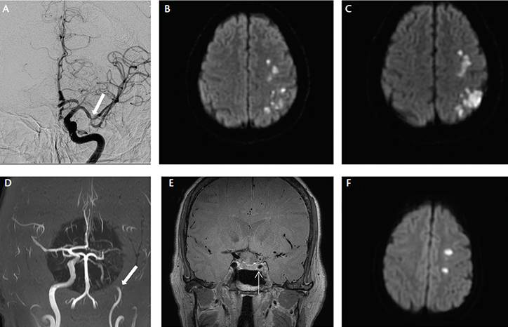 Infectious Causes of Stroke