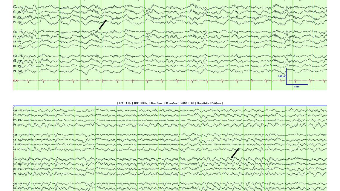 Figure 1 from the Epilepsy Essentials column article by Dr Smith and Dr Britton consisting of an EEG recording