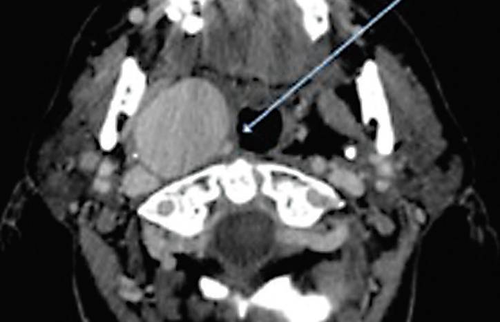 An Unusual Presentation of Syncope in a Patient With a Giant Cervical Carotid Aneurysm