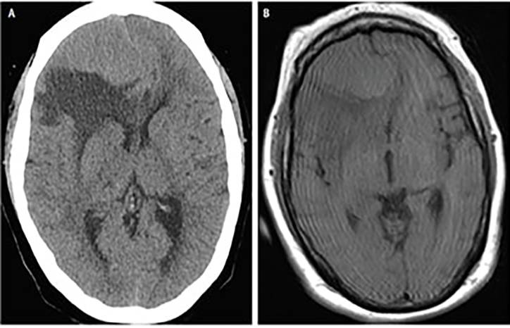 Special Report Neuro oncology