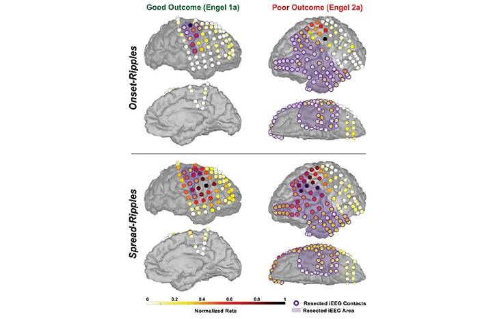Epilepsy Essentials Novel Interictal Biomarkers for Delineating the Epileptogenic Zone in Children With Drug Resistant Epile