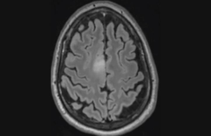 Challenge Case Report New Onset Seizures