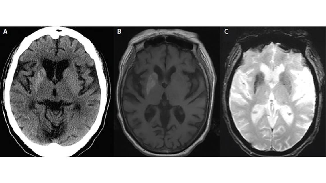 Case Report Hemichorea in a Woman With Diabetes